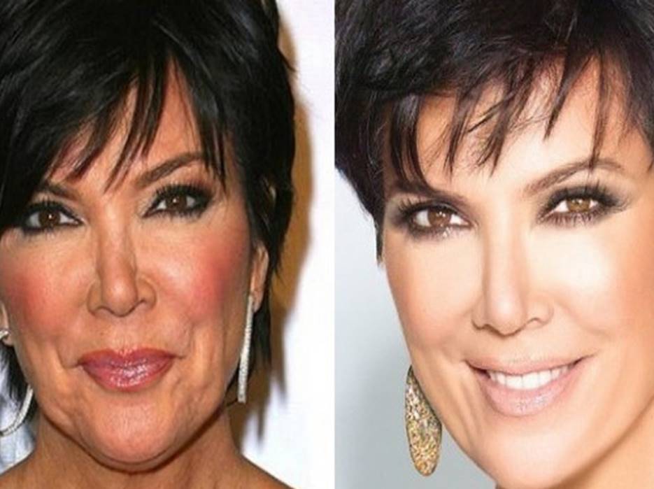 Kris Jenner’s Before And After Plastic Surgery Photos Show She Looks Better As She Ages My