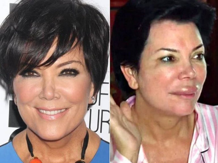 Kris Jenners Before And After Plastic Surgery Photos Show She Looks Better As She Ages My 2308